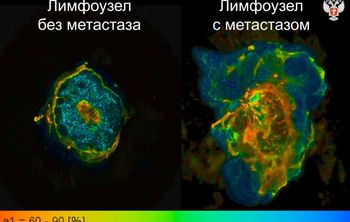 Ученые разработали метод экспресс-диагностики лимфоузлов при раке молочной железы